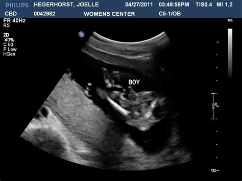 The Hegerhorst's: Keagan Vaughn...Baby BOY #2 18 week ultrasound