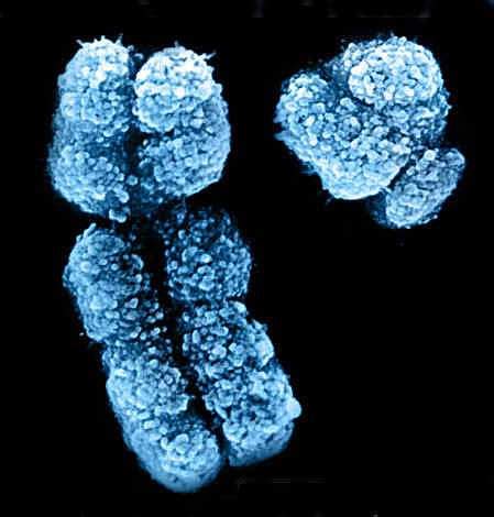 Loss of Y chromosome in blood cells associated with developing Alzheimer's disease