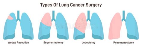 Lungs Cancer Surgery Types. Wedge Resection, Segmentectomy Stock Vector ...