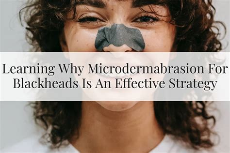 Microdermabrasion For Blackheads: A Solution Is Here (2023)