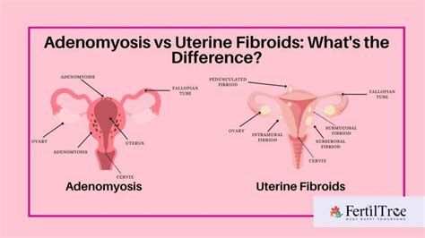 Adenomyosis vs Uterine Fibroids: What's the Difference? : Fertiltree IVF Center