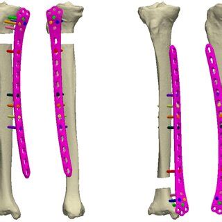 Anterior view of bone-plate constructs with an unstable,... | Download Scientific Diagram