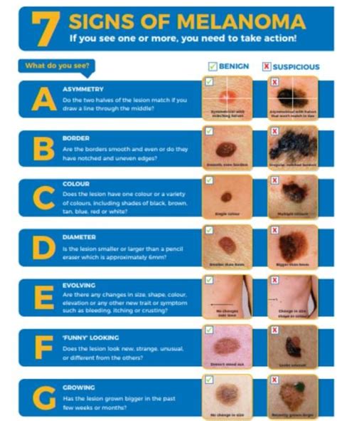 Is your birthmark hiding a melanoma?