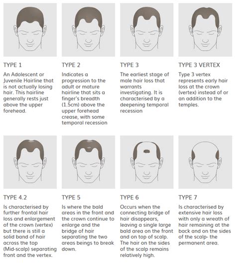 Types of Hair Loss - Essex Hair Clinic