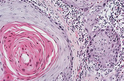 Keytruda Approved for Locally Advanced Cutaneous Squamous Cell Carcinoma