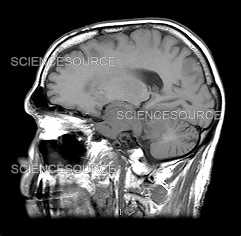 Photograph | Skull Base Meningioma 3 | Science Source Images