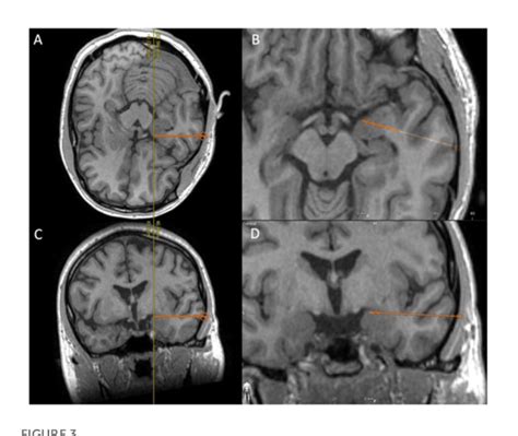 The role of the piriform cortex in temporal lobe epilepsy: A current literature review ...