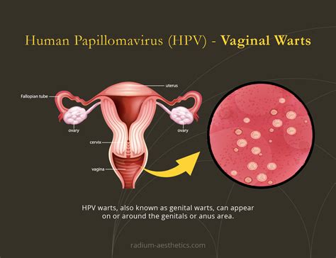 HPV Screening | Radium Medical Aesthetics Singapore