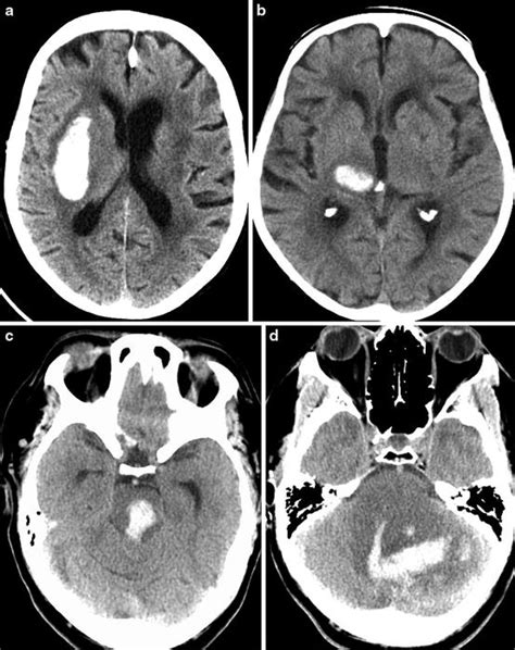 Intracerebral Hemorrhage Ct