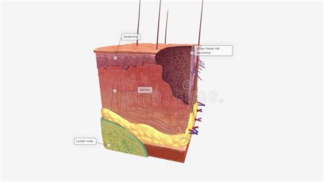 Basal Cell Carcinoma in Tissue, Stage 0 Stock Illustration ...