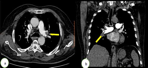 Cureus | Bilateral Pulmonary Embolism in Patients Recovered From Asymptomatic COVID-19 Infection