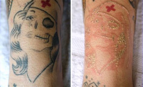 How to Remove Temporary Tattoos? | Up Best Home