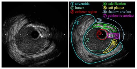 Applied Sciences | Free Full-Text | IVUS Image Segmentation Using Superpixel-Wise Fuzzy ...