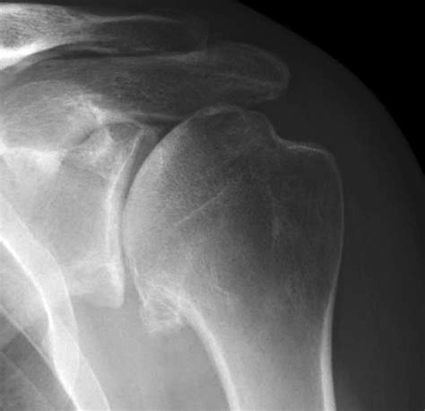 UW Shoulder and Elbow Academy: Degenerative joint disease ...