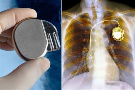 Batteryless Pacemaker Could Function Through Kinetic Heart Energy | The ...