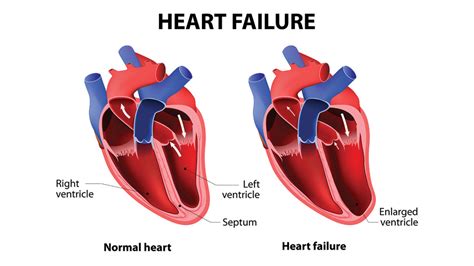 What is Heart Failure? – PB Cardiovascular