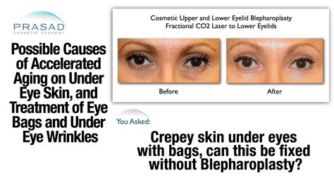 The Causes of Puffy Eye Bags and Thinned Skin Under the Eyes, and Treatments for Both - YouTube