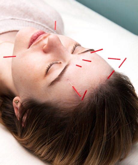 Facial Acupuncture - Natural Anti Aging