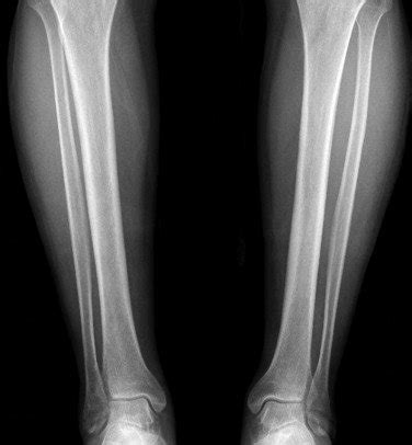 Bilateral antero-posterior X-ray graphy of tibias. | Download Scientific Diagram