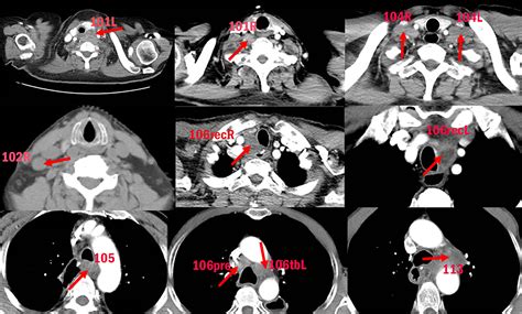 Frontiers | Mapping of Cervical and Upper Mediastinal Lymph Node ...