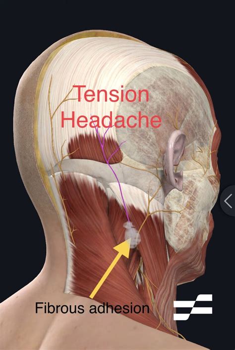 Migraines Muscle