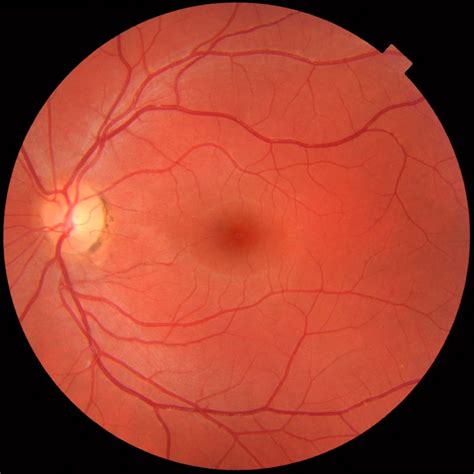 Macular degeneration - Age related, Causes, Types, Symptoms, Treatment