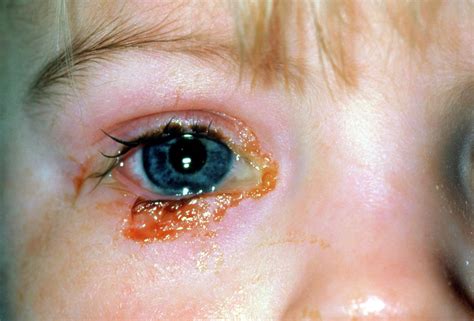 Bacterial Conjunctivitis