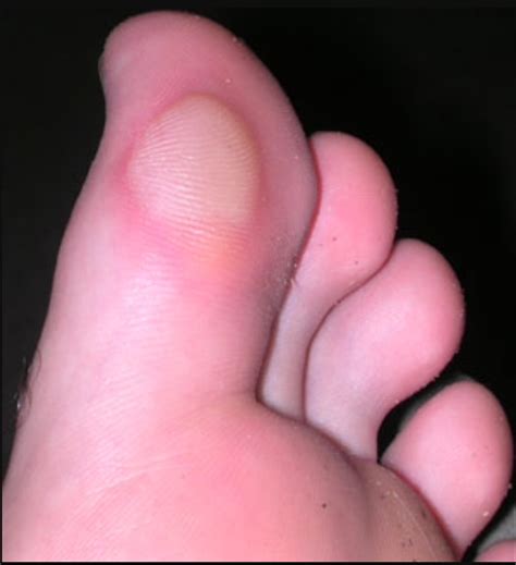 Blisters | George's medical information