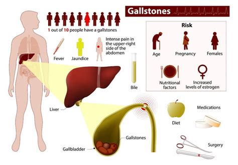 Gallstones Symptoms Treatment Causes Pain Surgery | My XXX Hot Girl