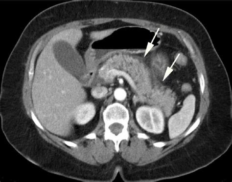 Cureus | Acute Interstitial Pancreatitis With a Normal Lipase Level in the Background of ...