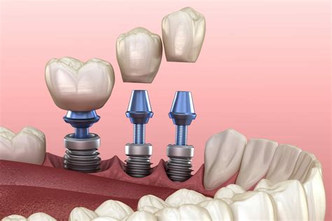 Dental Implants Process | Dental Implant Recovery