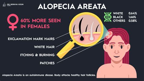 Alopecia Areata: Explaining Autoimmune Hair Loss - Dr Serkan Aygin Clinic