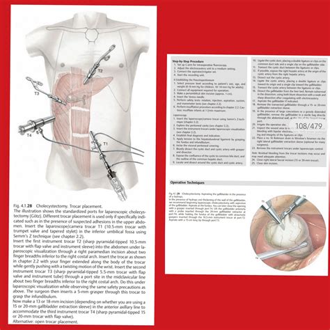 DR AFTAB AHMED on Twitter: "1/2 Beautiful Picturization of Laparoscopic ...