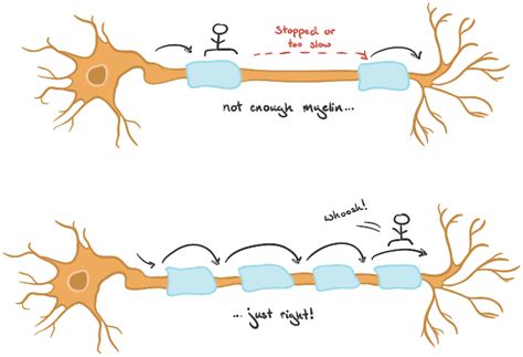 Multiple Sclerosis Neuron