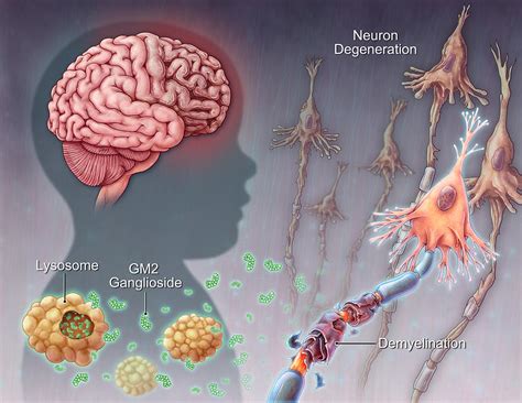 Tay-sachs Disease, Illustration #2 Photograph by Evan Oto - Fine Art ...