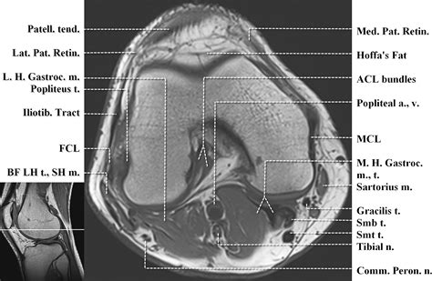 Knee Muscle Anatomy Mri Das Knie Mrt Anatomieatlas In | The Best Porn ...