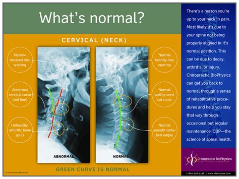 Normal vs. Abnormal Cervical X-Ray – Chiropractic BioPhysics