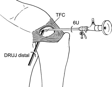 The role of arthroscopic synovectomy in patients with undifferentiated ...