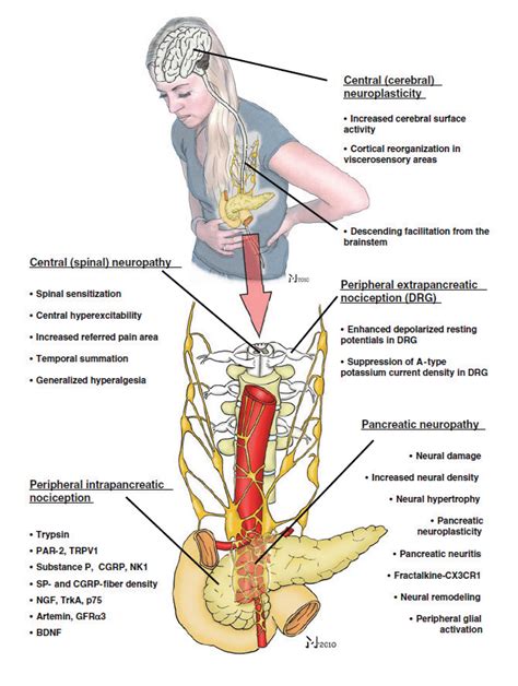 The main causes of pain in chronic pancreatitis. Neuropathic pain in ...