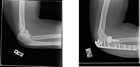 Elbow Fractures Specialist - Bethesda, MD, Rockville, MD, & Germantown ...