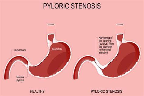 Pyloric Stenosis In Babies: Symptoms, Causes And Treatment