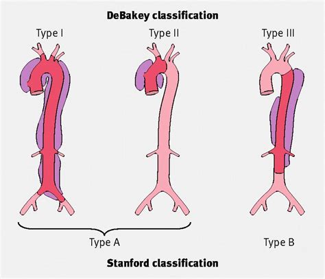 Aortopathy - Cardio Guide