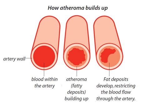 atheroma