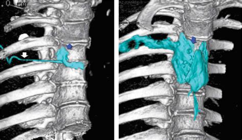 Paravertebral Nerve Block Ultrasound