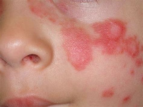 Discoid Lupus - Pictures, Symptoms, Treatment, Causes