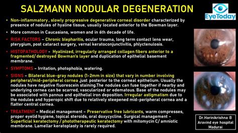 Salzmann Nodular Degeneration - EyeToday