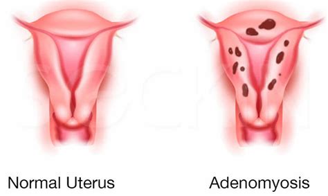 Adenomyosis, adenomyosis & pregnancy, symptoms, diagnosis & treatment