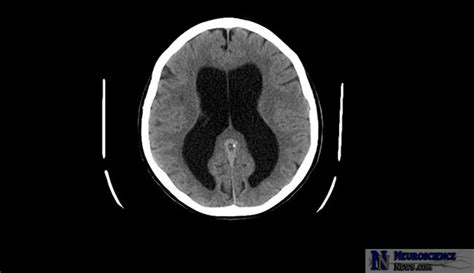 First Evidence on Effectiveness of Shunt Operations for Dementia ...