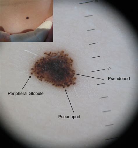 Dermoscopy Made Simple: Spitz Nevus