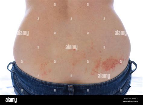 Scabies is a contagious parasitic skin disease caused by mites burrowing into the skin Stock ...